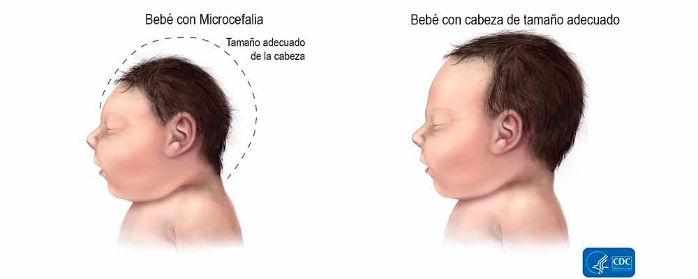 Microcefalia en el bebé
